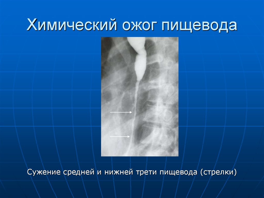 Диета При Стенозе Пищевода