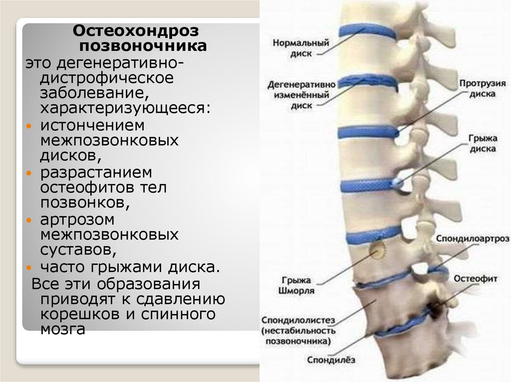 Остеохондроз позвоночника презентация