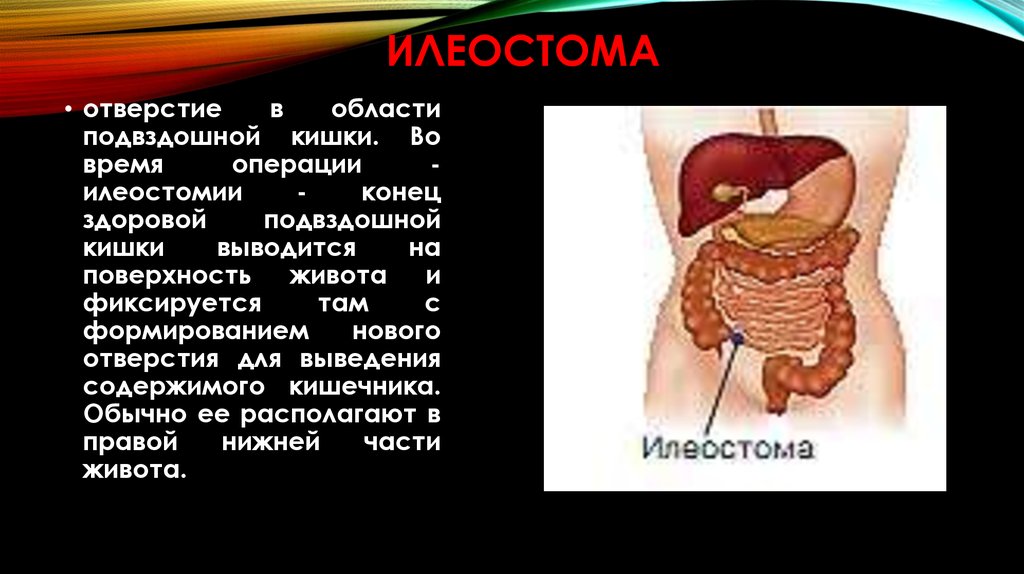 Диета После Закрытия Илеостомы Тонкой Кишки