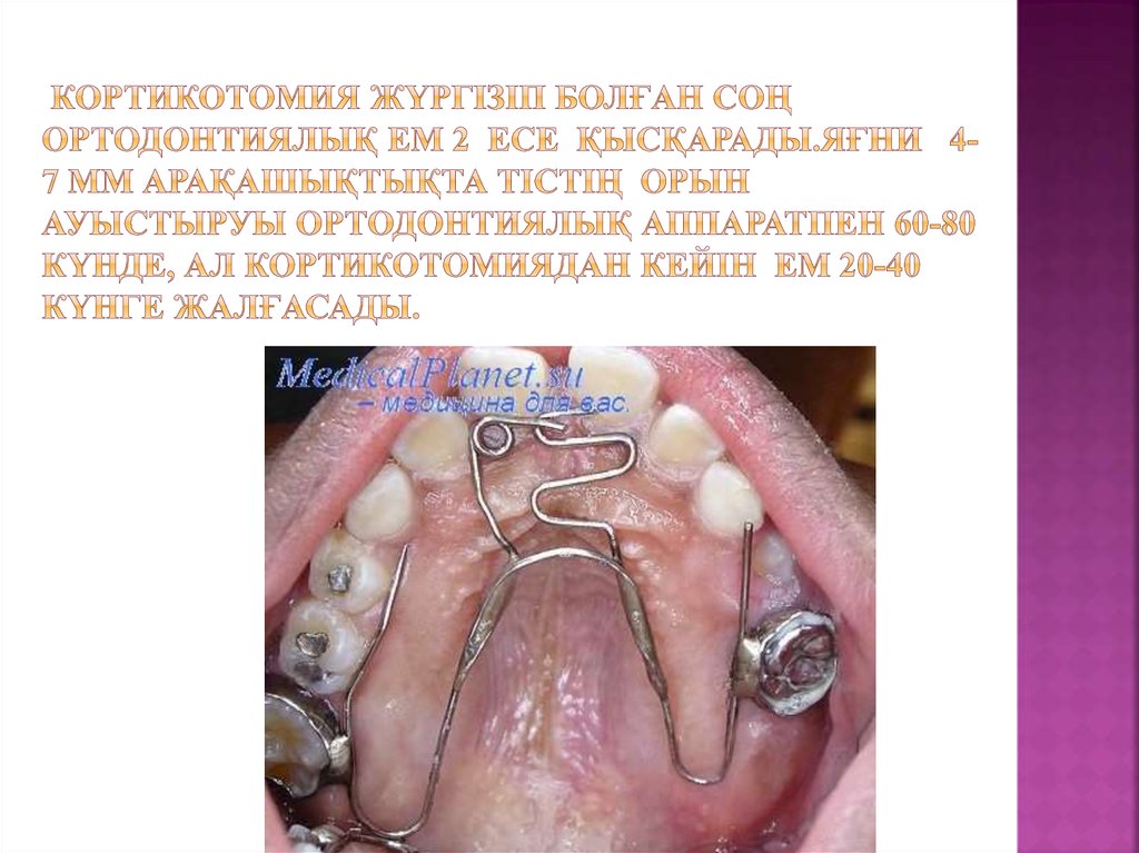 Кортикотомия жүргізіп болған соң ортодонтиялық ем 2 есе қысқарады.Яғни 4-7 мм арақашықтықта тістің орын ауыстыруы ортодонтиялық