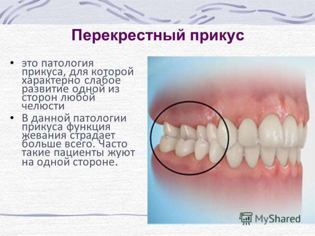 Прямой прикус картинка