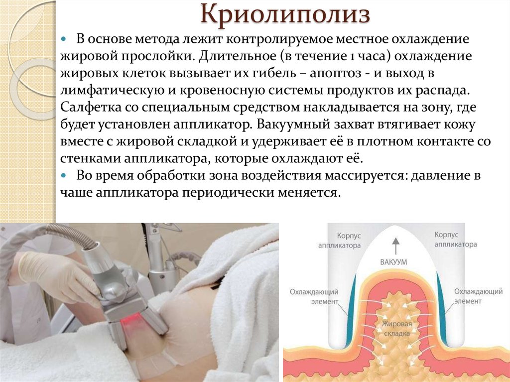 Криолиполиз реклама в картинках