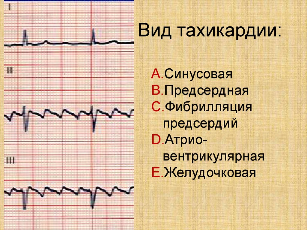 Лишний Вес Тахикардия