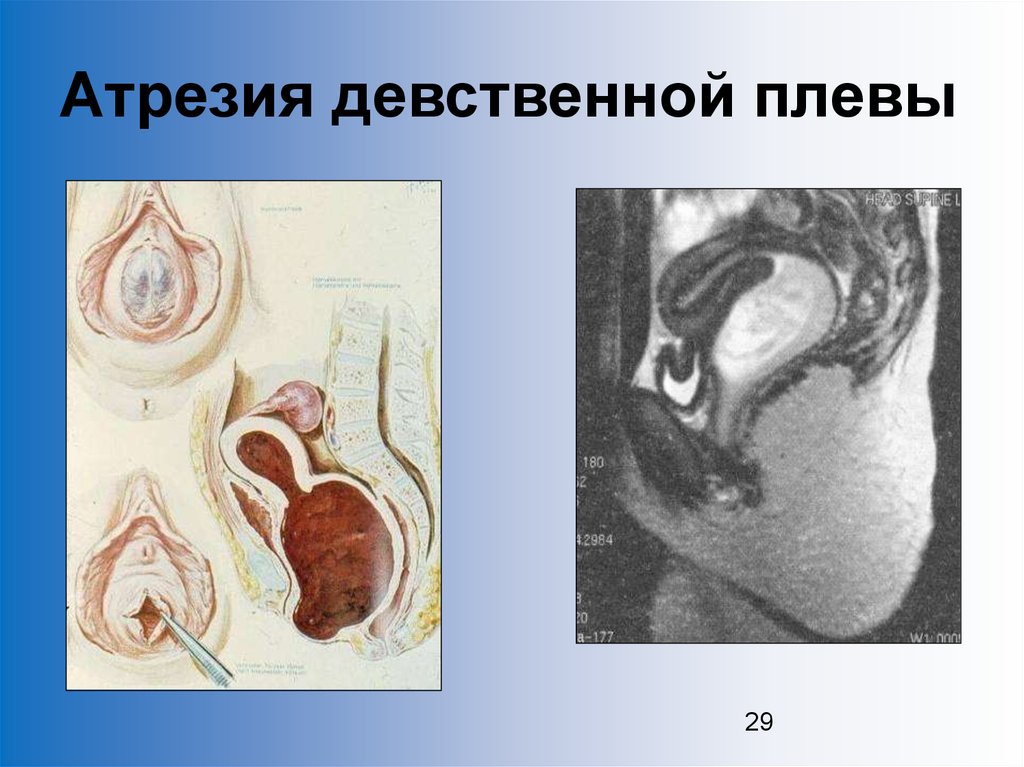 Вагина Девственницы До И После