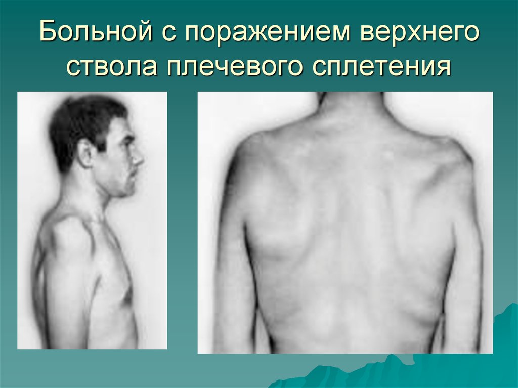 Нижний поражение. Плечевая плексопатия синдром. Верхний плексит Дюшенна Эрба. Верхний плексит плечевого сплетения.