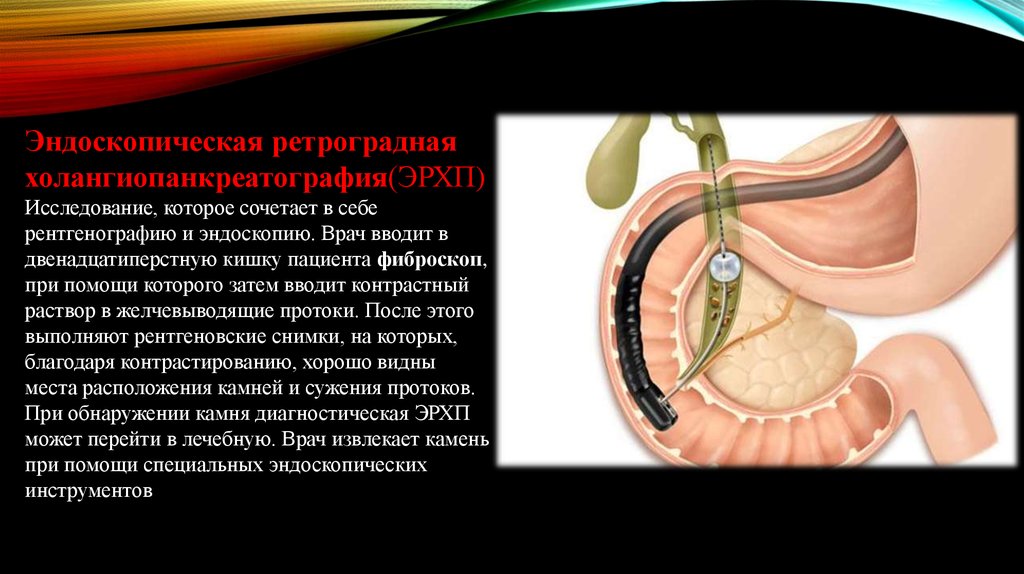 Печеночная колика - презентация онлайн