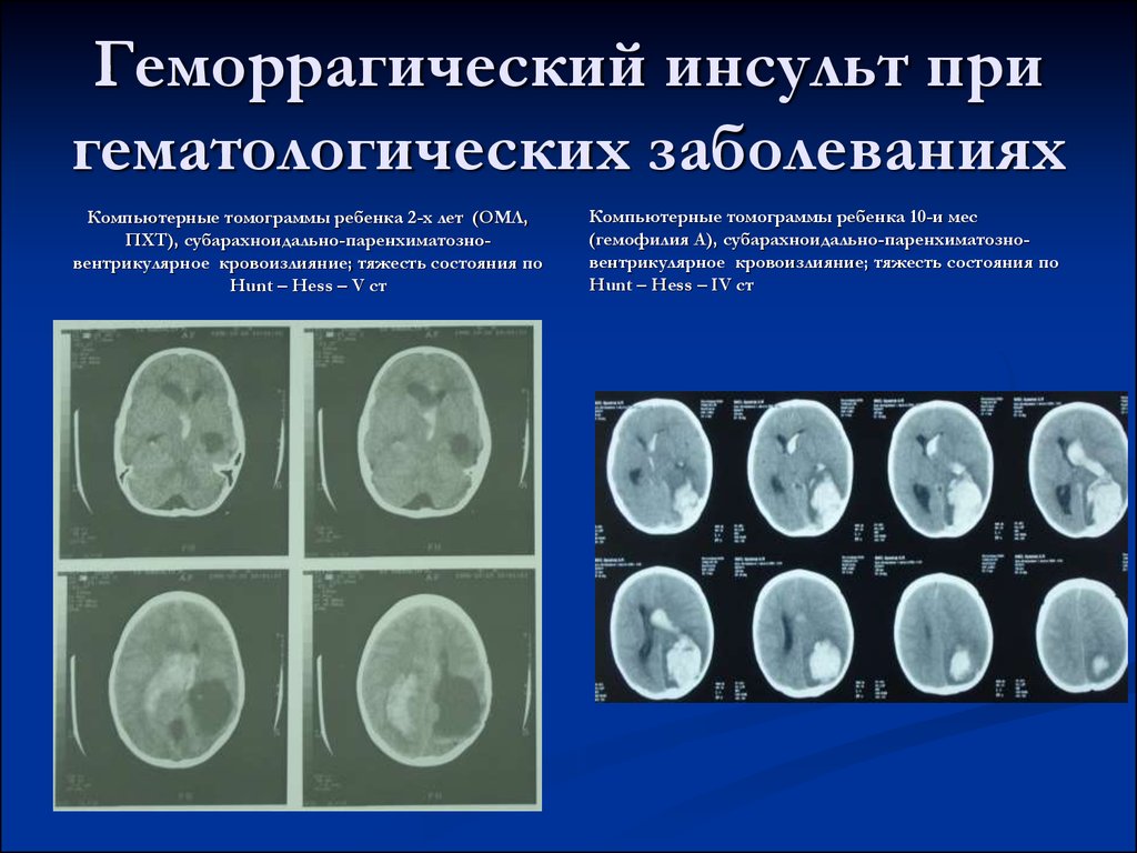 Был геморрагический инсульт