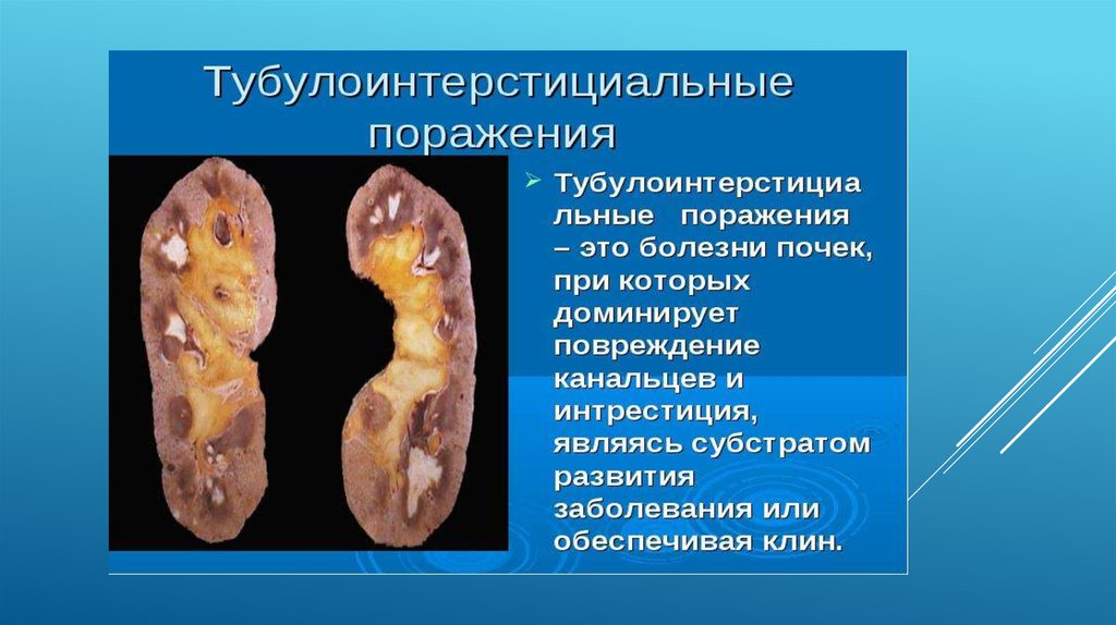 Тубулоинтерстициальный нефрит презентация