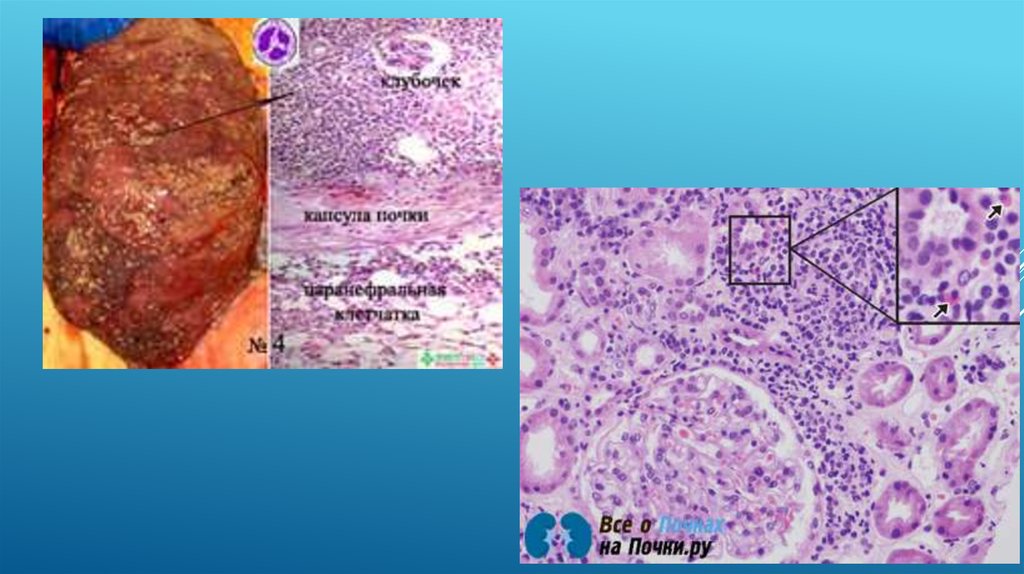 Хронический тубулоинтерстициальный нефрит презентация