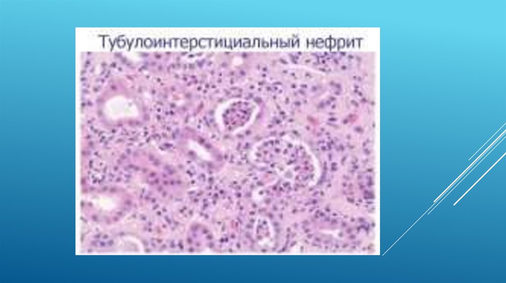 Хронический тубулоинтерстициальный нефрит презентация
