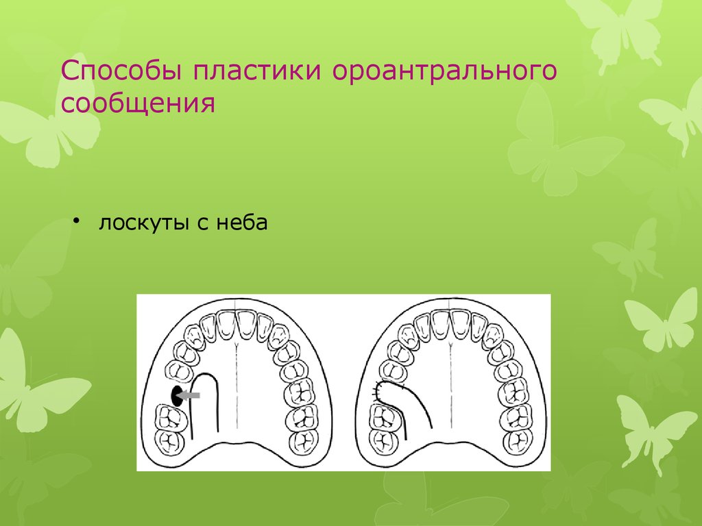 Одонтогенный верхнечелюстной синусит презентация