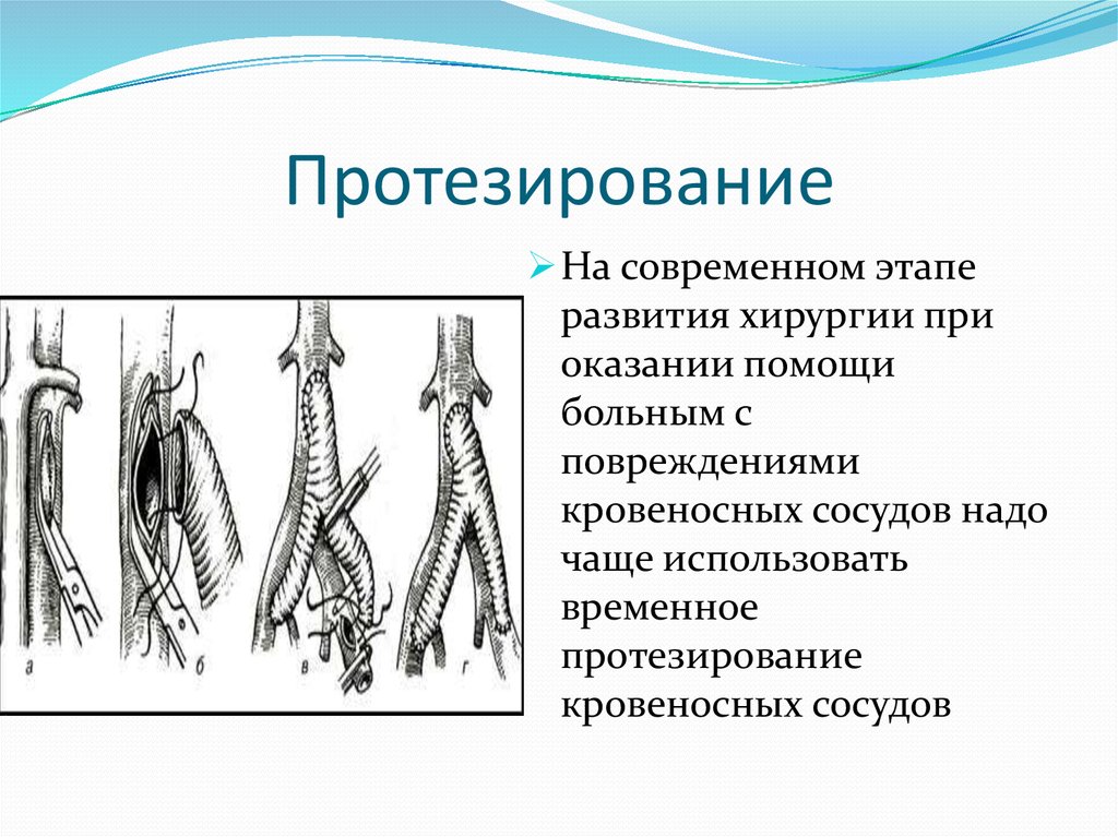 Протезирование сосудов презентация