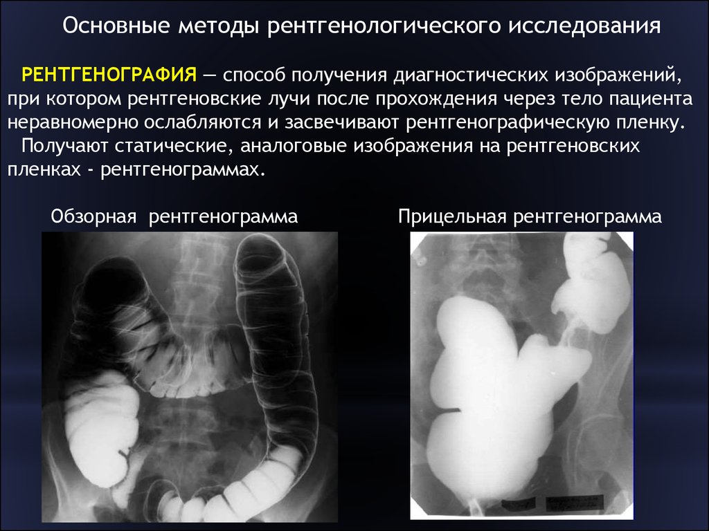 При рентгеноскопии изображение получается