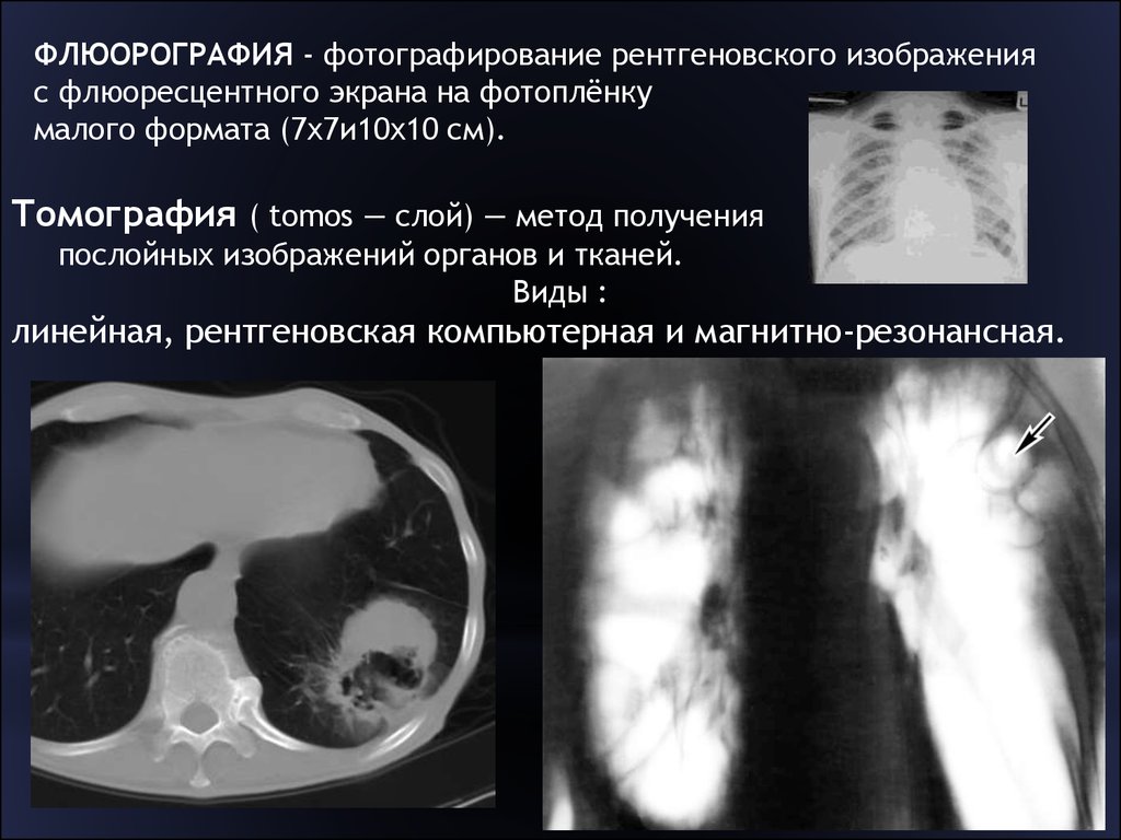 Чем отличается флюорография от рентгена. Флюорография и рентген отличия. Линейная томография лучевая диагностика. Флюорография -метод получения рентгеновского изображения. Рентгеновская томография флюорография.