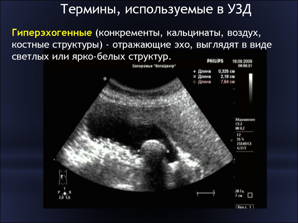 Гиперэхогенные диффузные. Гиперэхогенные структуры на УЗИ. Гиперэхогенное образование на УЗИ. Гиперэхогенная структура. Гиперэхогенные структуры эхогенные структуры.