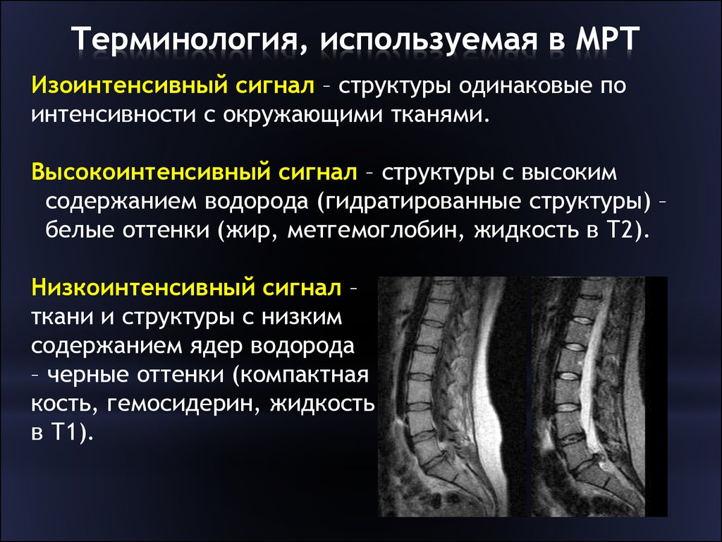 На т2 взвешенных изображениях при нативной магнитно резонансной томографии хорошо визуализируются