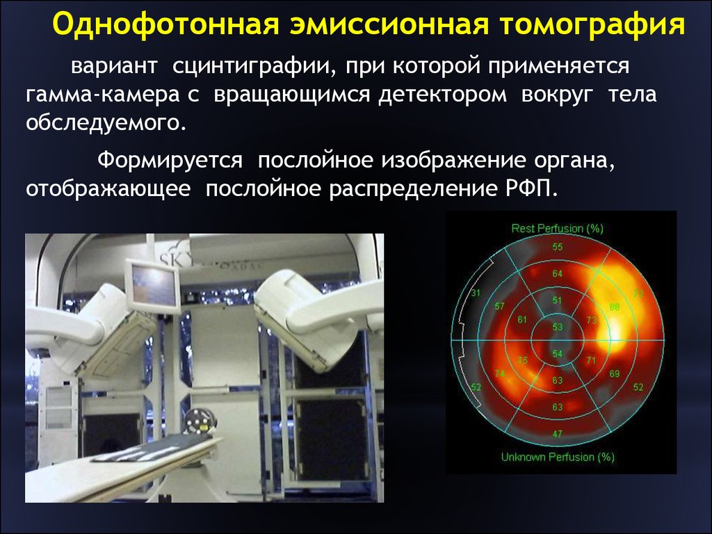 Лучевые исследования. ОФЭКТ гамма камера. Сцинтиграфия легких ОФЭКТ кт. Однофотонная эмиссионная компьютерная томография (ОЭКТ).. ОФЭКТ лучевая диагностика.