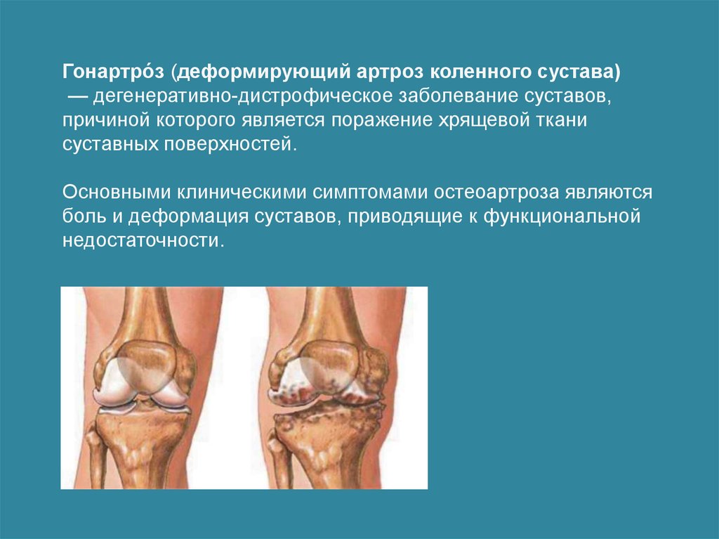 Гонартроз по утвержденным клиническим рекомендациям. Деформирующий артроз коленного сустава. Дегенеративные поражения суставов. Дистрофические изменения коленного сустава. Дегенеративные изменения коленного сустава.