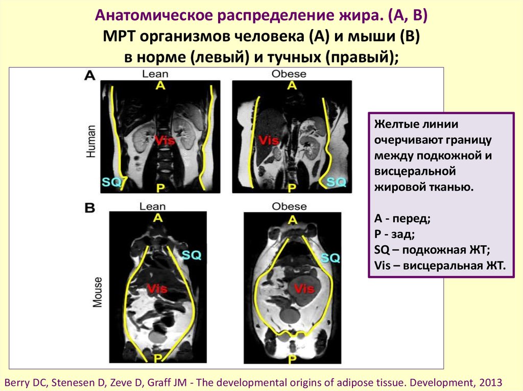 Распределение жира. Распределение висцерального жира в организме.