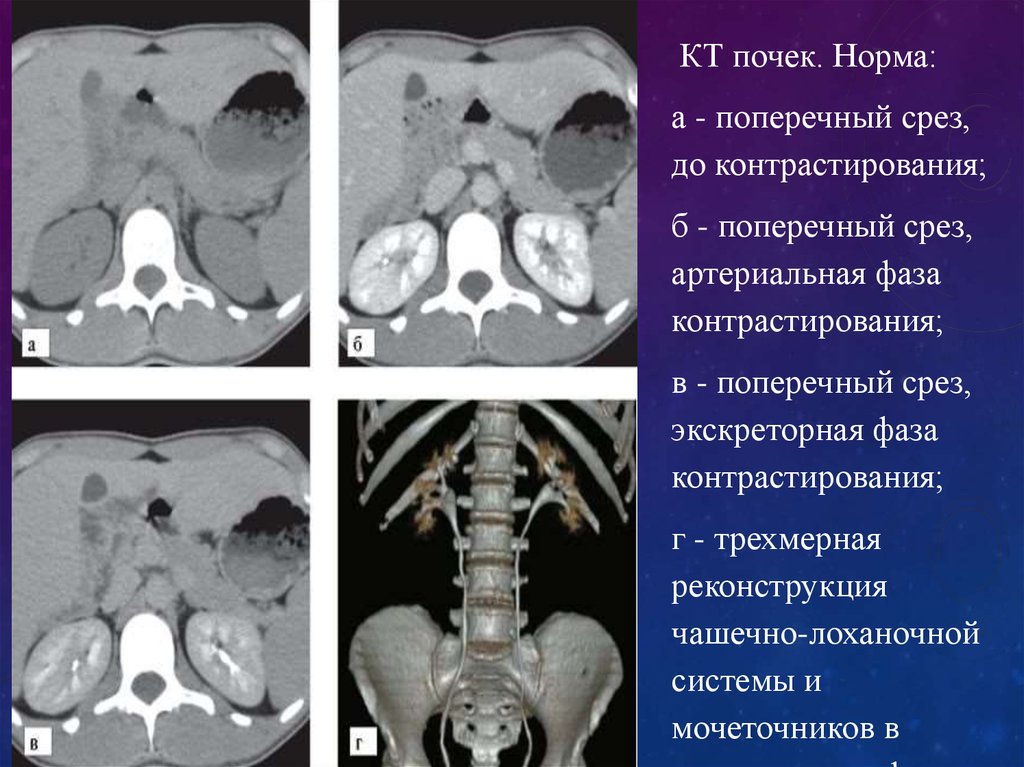 Кт почек