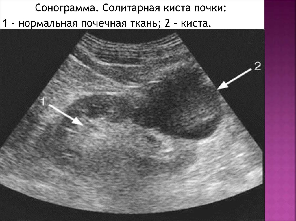 Процедура узи надпочечников