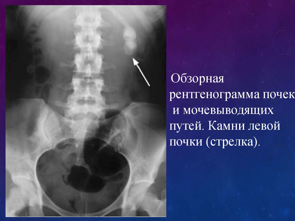 Рентгенография почек. Обзорная рентгенограмма почек и мочевых путей камень. Рентгенография почек и мочевыводящих путей. Обзорная рентгенограмма. Конкремент левой почки.