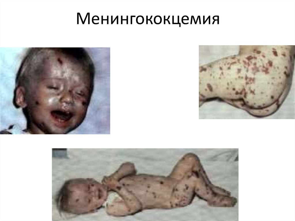 Менингококцемия