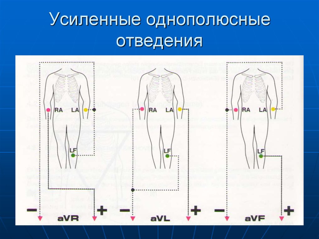 Усиленные отведения экг схема