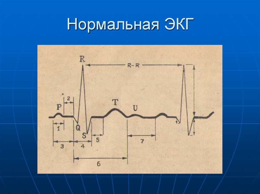 Нормальная экг картинка