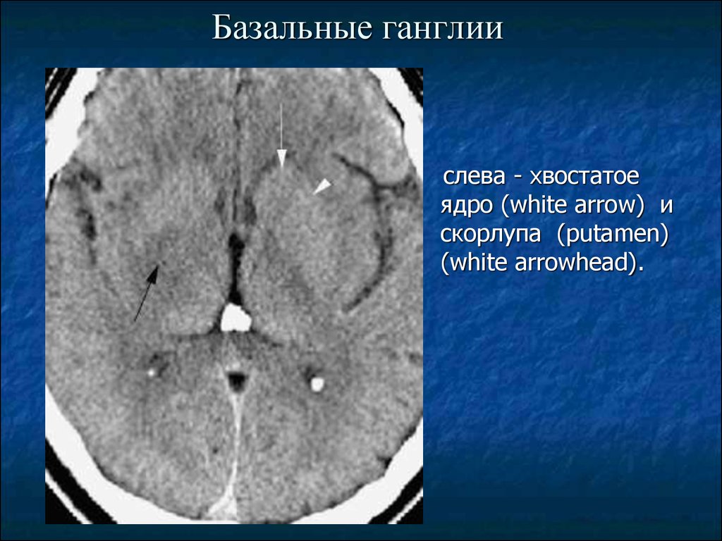 Базальные ядра головного мозга фото