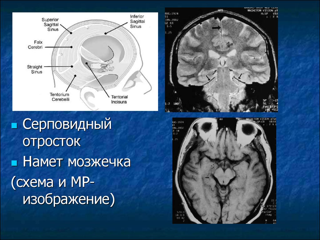 Мозжечок на кт. Анатомия мозжечка кт. Анатомия головного мозга кт анатомия. Намет мозжечка анатомия мрт. Намет мозжечка анатомия кт.