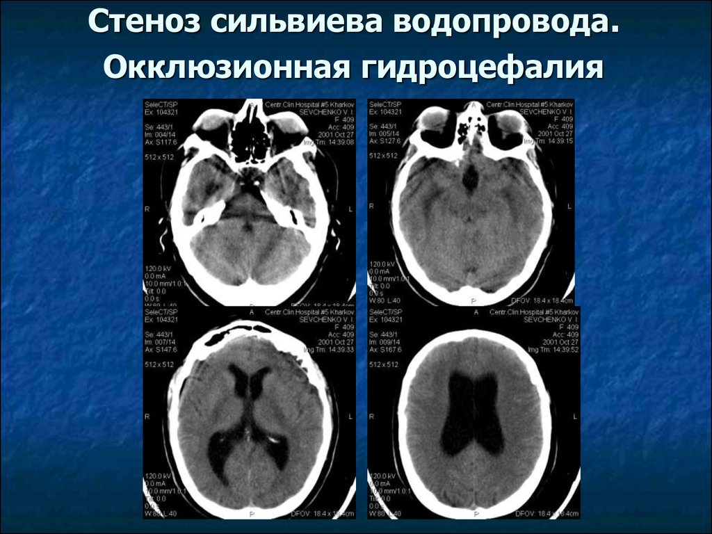 Последствия гидроцефалии головного мозга. Гидроцефалия головного мозга на кт. Гидроцефалия стеноз сильвиева. Стеноз сильвиева водопровода мрт. Кт головного мозга при гидроцефалии.