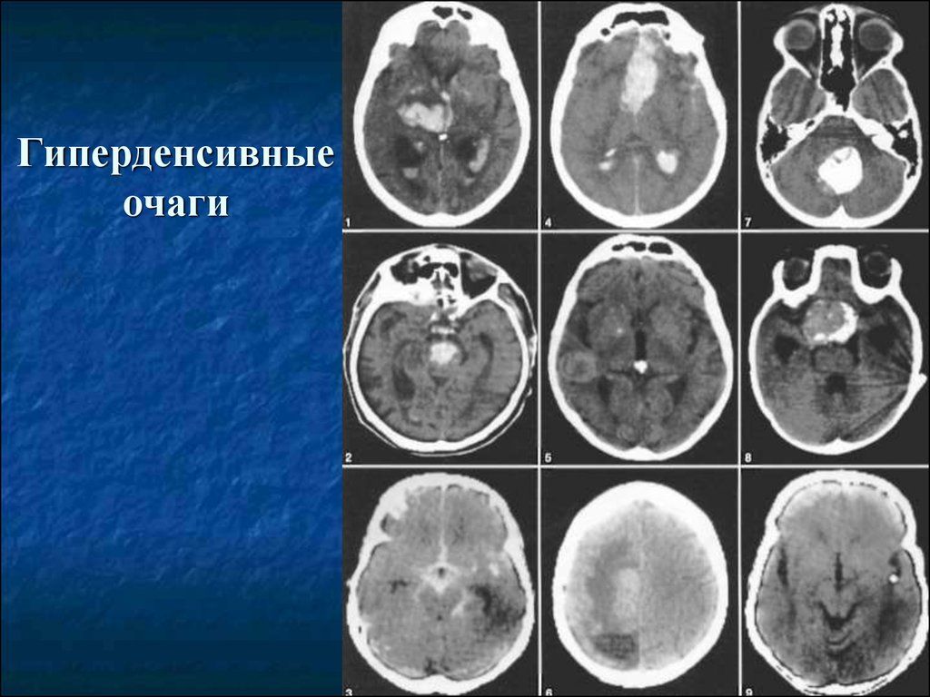 В серошкальном изображении гиперденсный участок