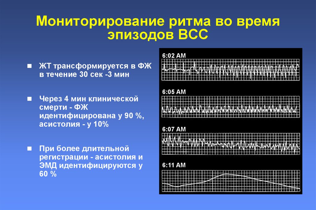 Признаки электромеханической диссоциации