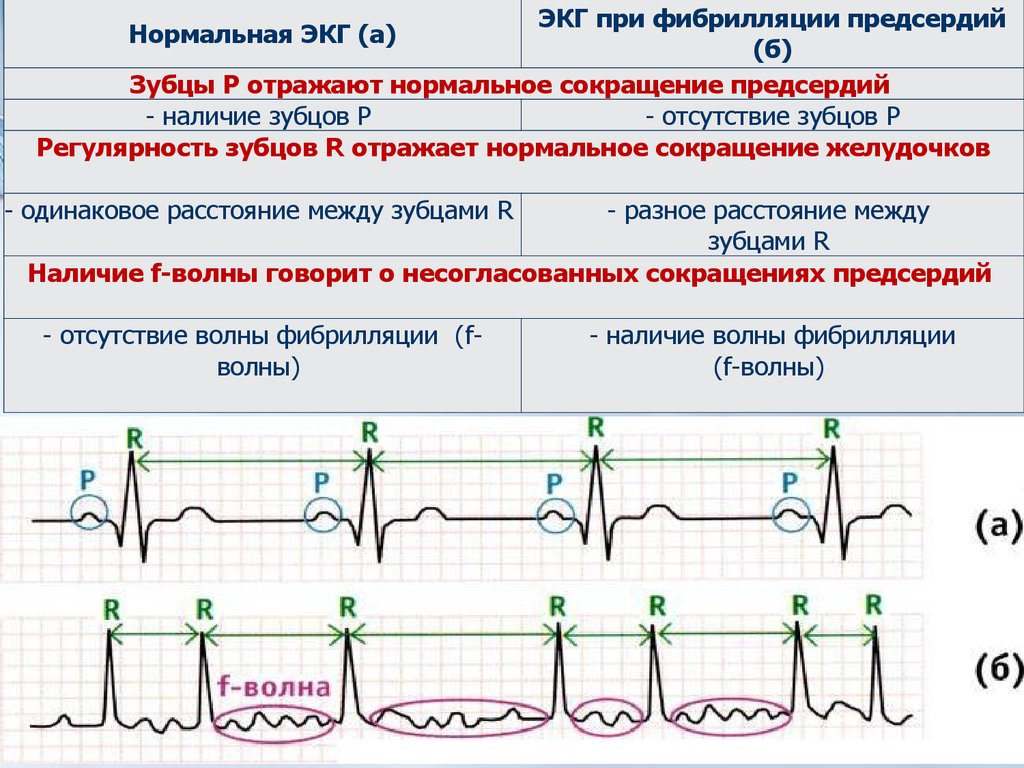 Трепетание предсердий карта вызова скорой медицинской помощи