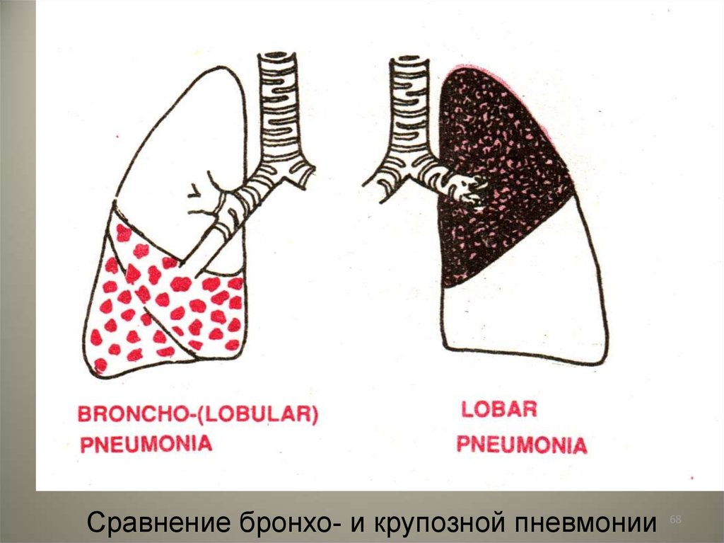 Усилен бронхо сосудистый рисунок