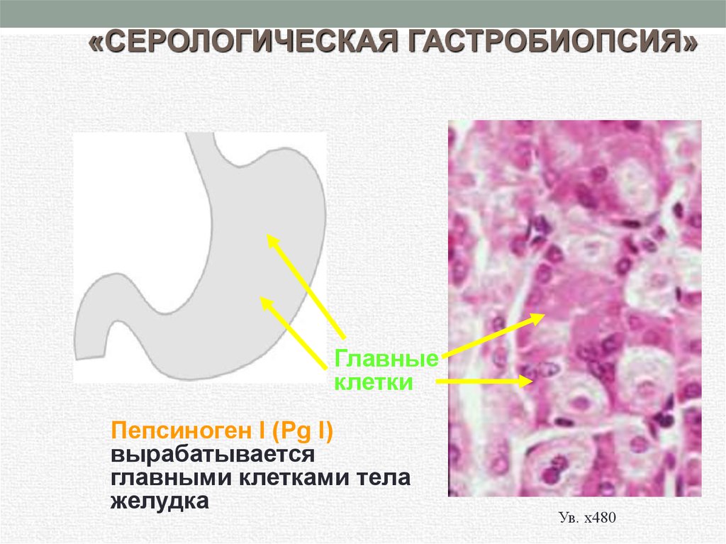 Главные клетки желудка вырабатывают. Презентация на тему хронический гастрит. Пепсиноген вырабатывается в железах желудка клетками.