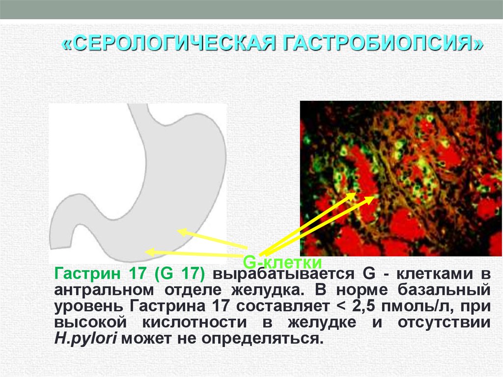 Для желудка характерно. Хронический антральный гастрит. Хроническая язва антрального отдела желудка. Хронический реактивный гастрит. Эрозии в антральном отделе желудка.