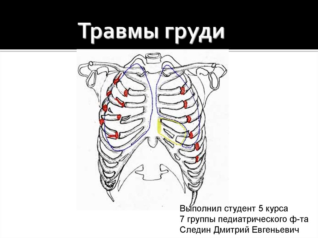 Картинки травма грудной клетки