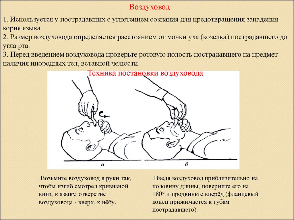 Нарушение проходимости дыхательных. Введение воздуховода алгоритм. Ротовой воздуховод применяется для предупреждения аспирации. Техника введения воздуховода. Введение воздуховода первая помощь.