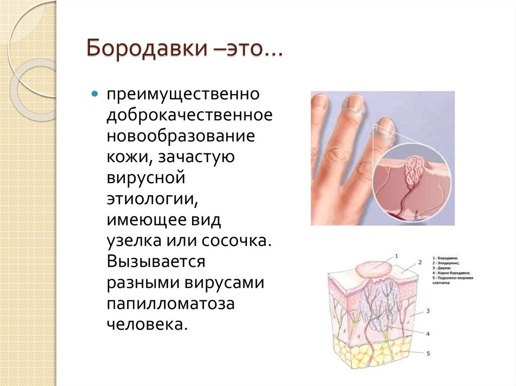 Презентация бородавки дерматовенерология