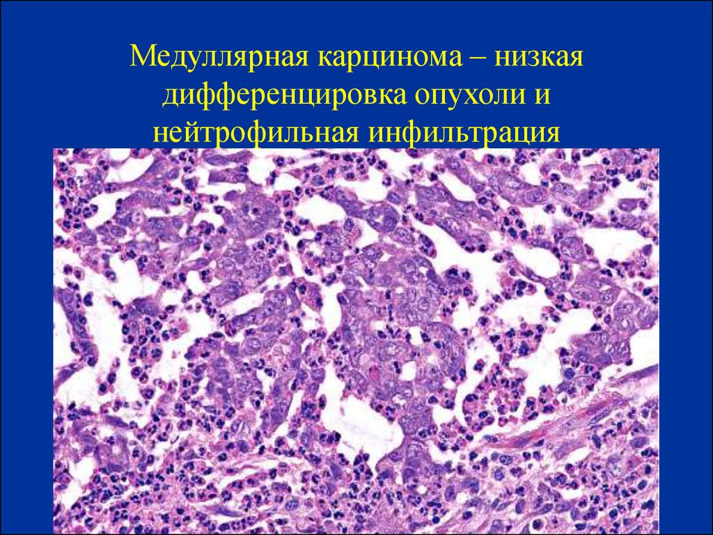 Медуллярный рак. Медуллярная карцинома гистология. Медуллярная аденокарцинома. Медуллярная карцинома макропрепарат. Аденокарцинома щитовидной железы гистология.