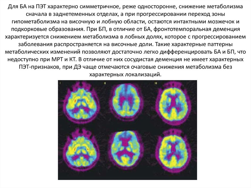 Лобная деменция