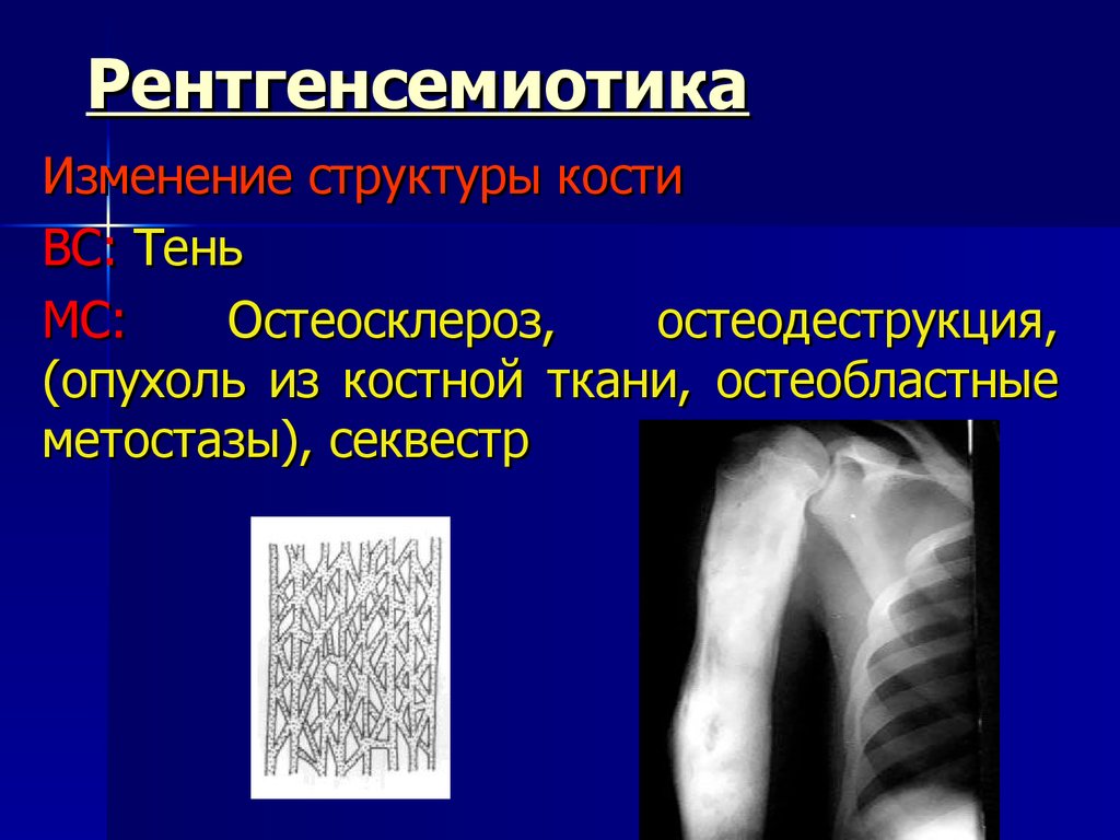 Изменение структуры кости. Остеосклероз кости рентген. Лучевые заболевания костей. Деструкция кости и остеосклероз. Остеобластные изменения костей.