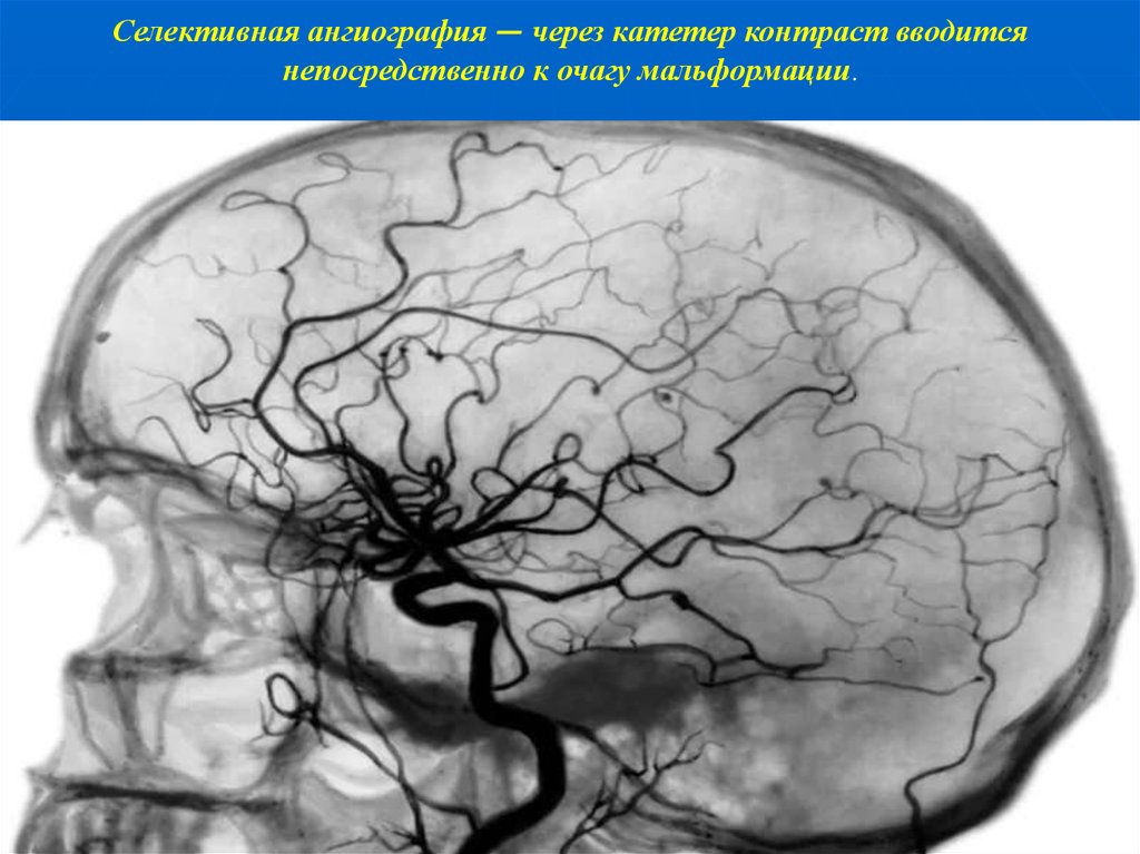 Ангиография сосудов головного