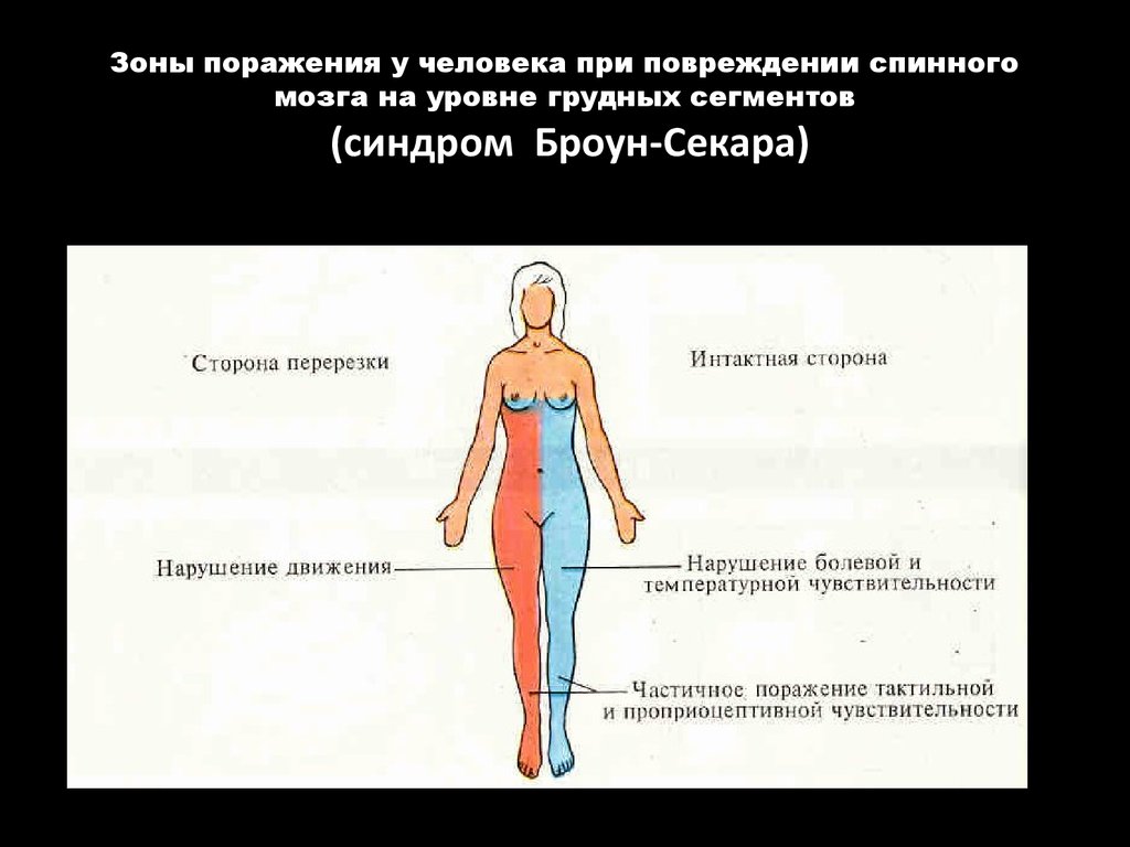 Синдром броун секара это. Синдром поражения половины поперечника спинного мозга. Синдром половинного поражения спинного мозга Броун Секара. Симптомы поражения половины поперечника спинного мозга. Синдром Броун Секара неврология на разных уровнях.