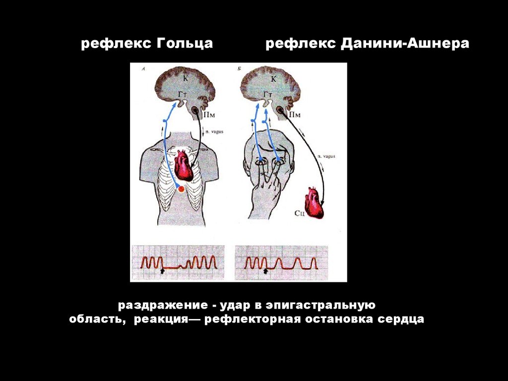 Глазосердечный рефлекс физиология схема