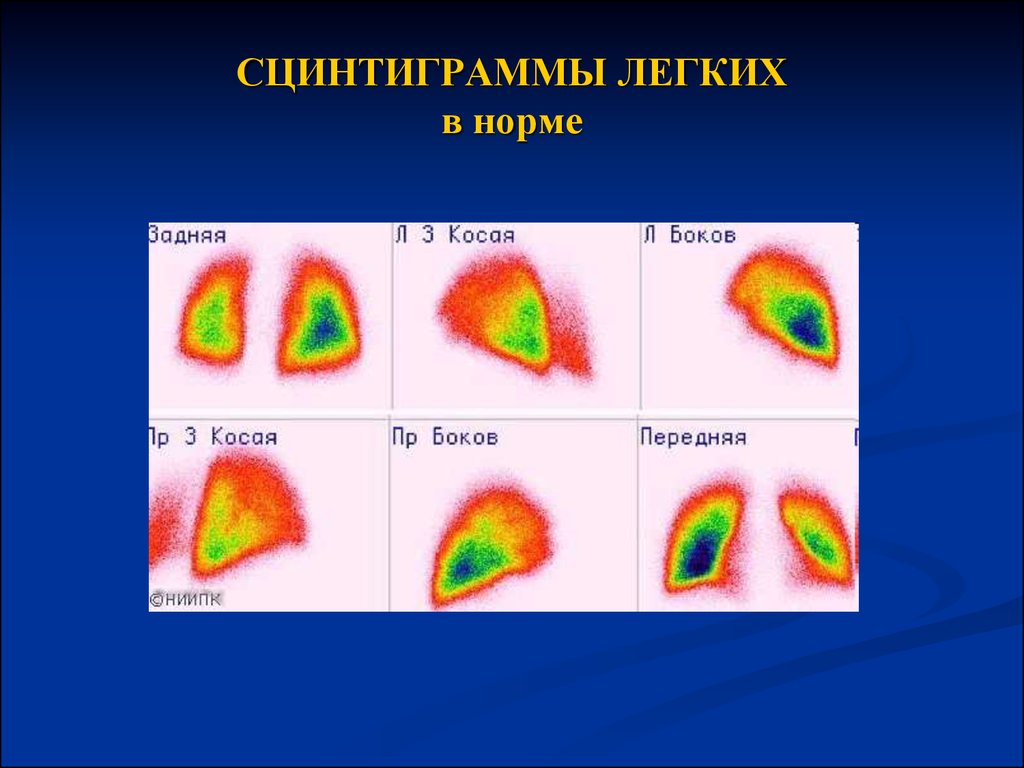 Сцинтиграмма является изображением