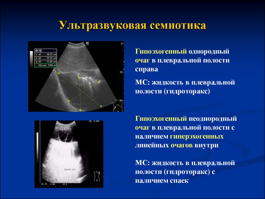 Узи плевральной. УЗИ исследование плевральной полости. Гидроторакс УЗИ плевральных полостей. Экссудативный плеврит УЗИ плевральной полости. УЗИ органов грудной клетки при гидротораксе.