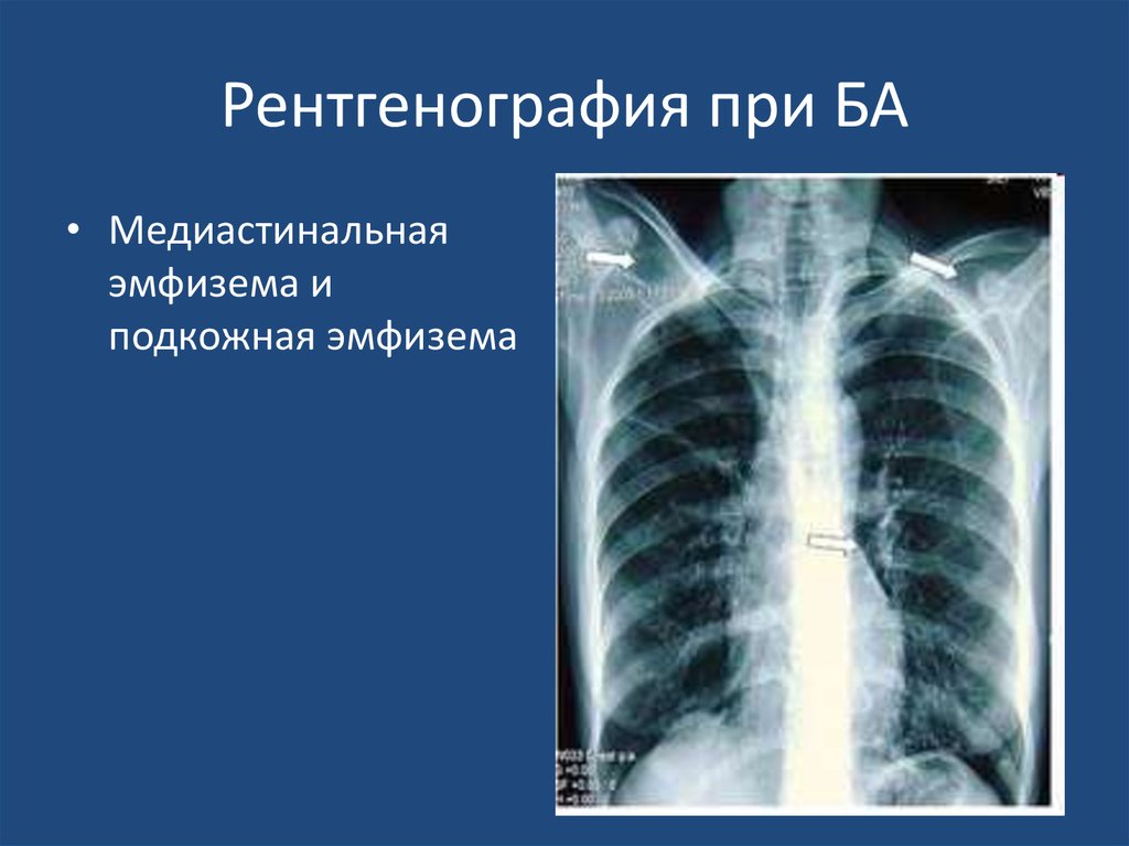 Рентгенологическая картина при хобл